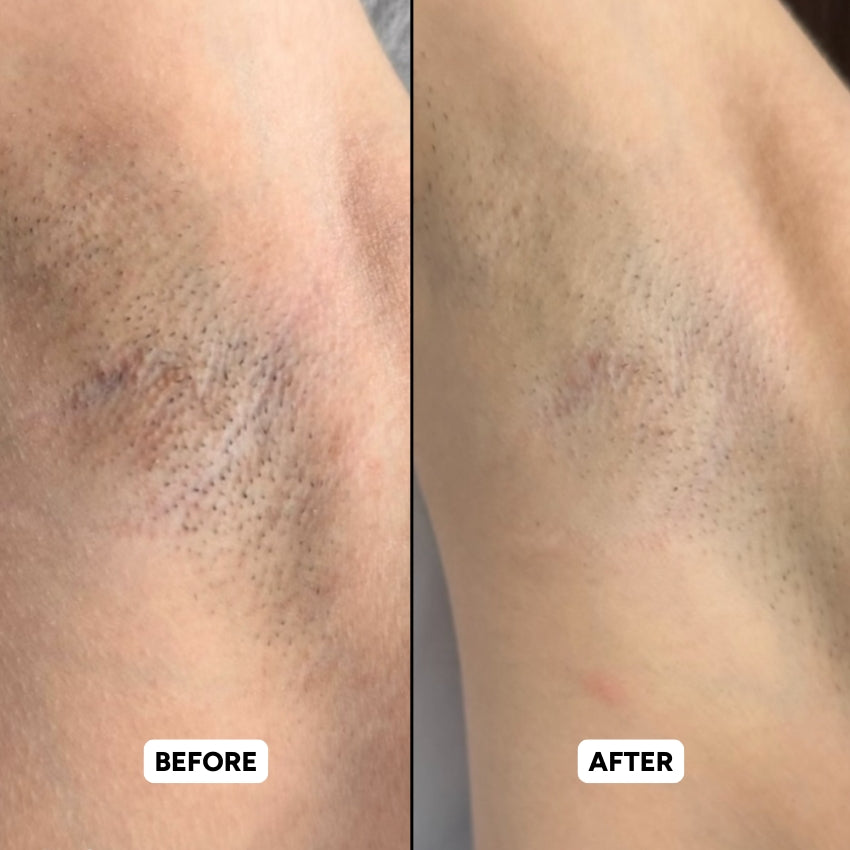 The Complete Intimate Skin Reset Before