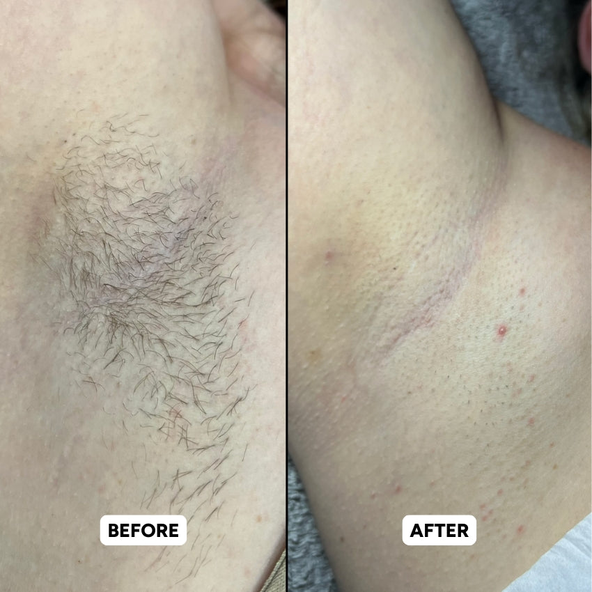 The Complete Intimate Skin Reset Before