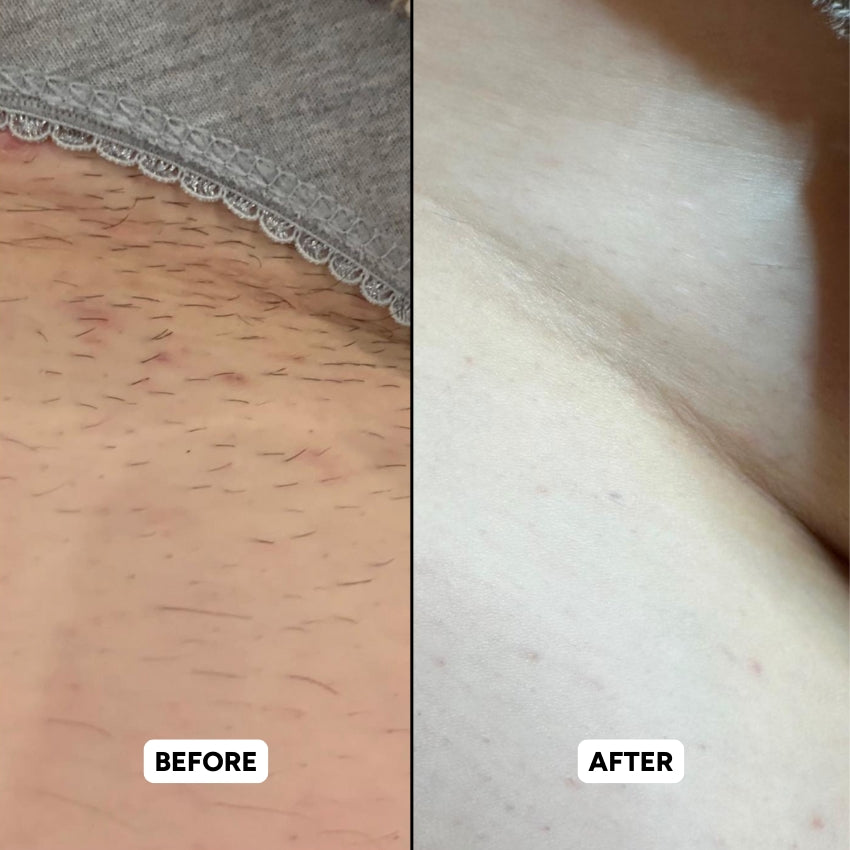 The Complete Intimate Skin Reset Before