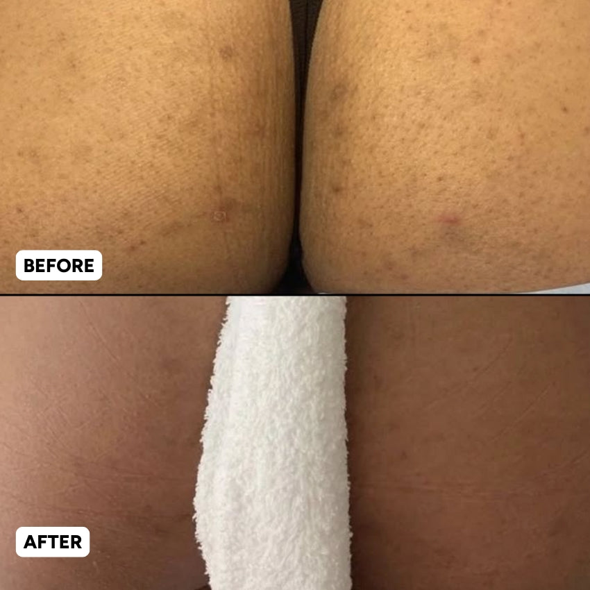 The Complete Intimate Skin Reset Before