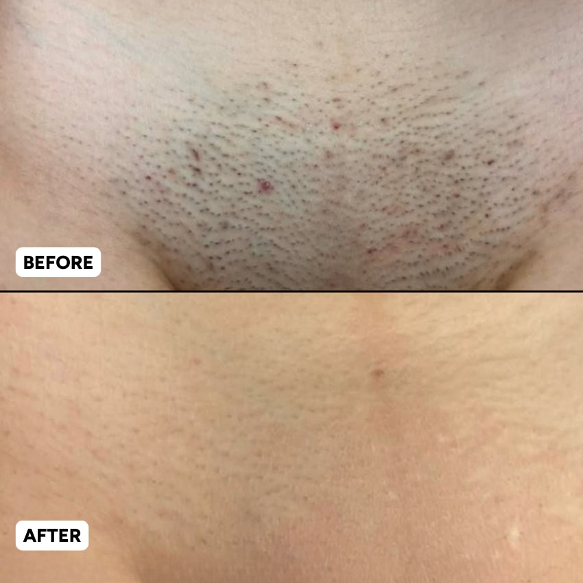 The Complete Intimate Skin Reset Before