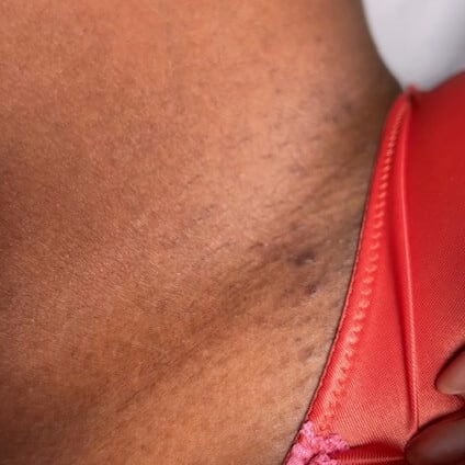 Dark Spots Routine Before