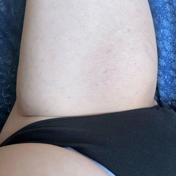 Scars Routine After