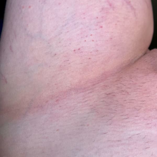 Scars Routine Before