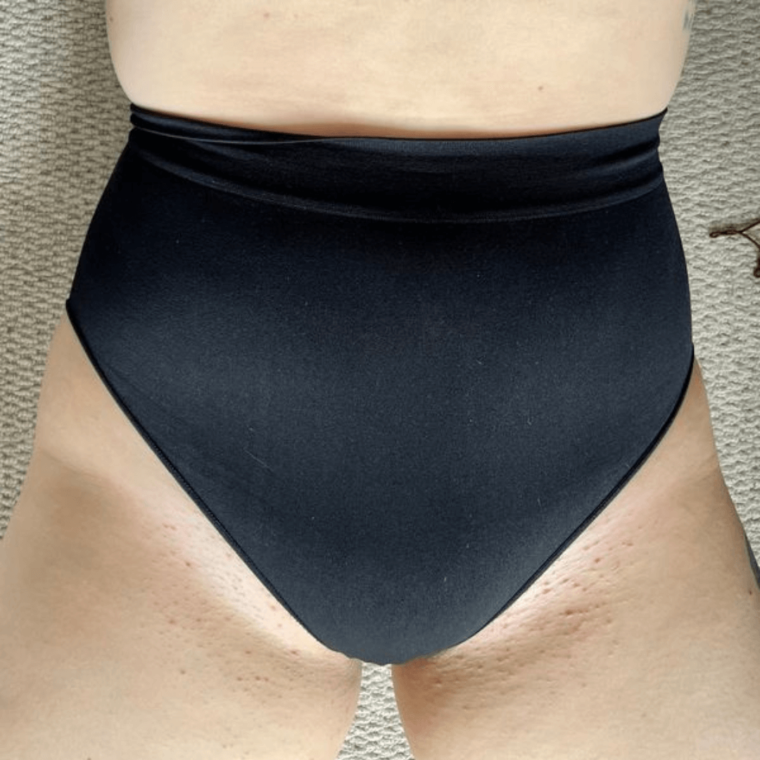 Ingrown Hairs Routine Before