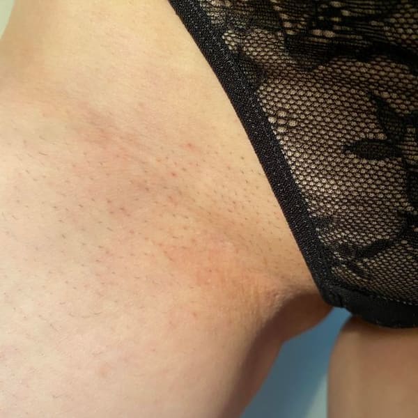 The Complete Intimate Skin Reset After