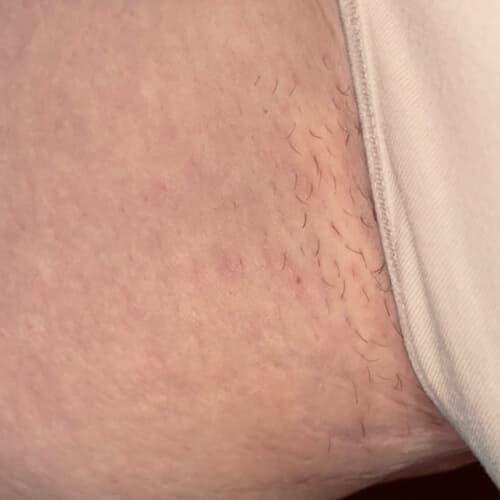 Scars Routine Before