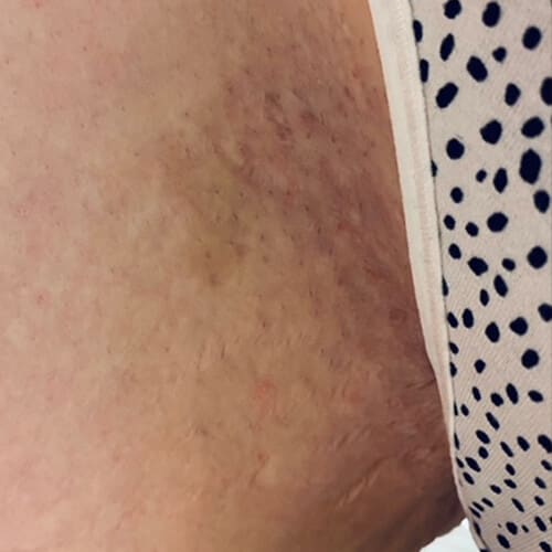 Scars Routine After