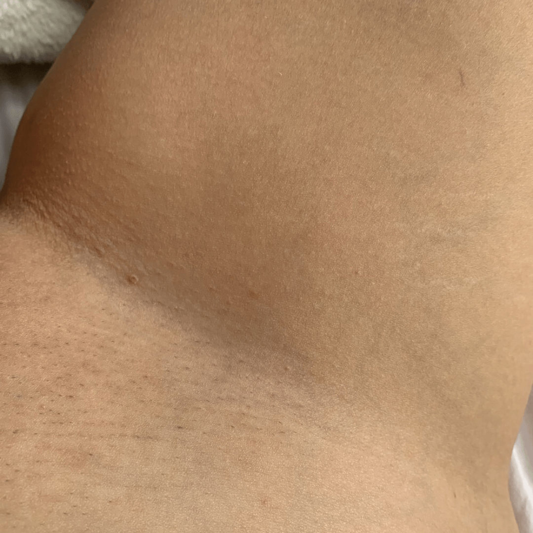 Ingrown Hairs Routine After