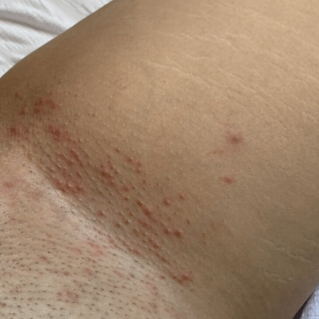 Ingrown Hairs Routine Before