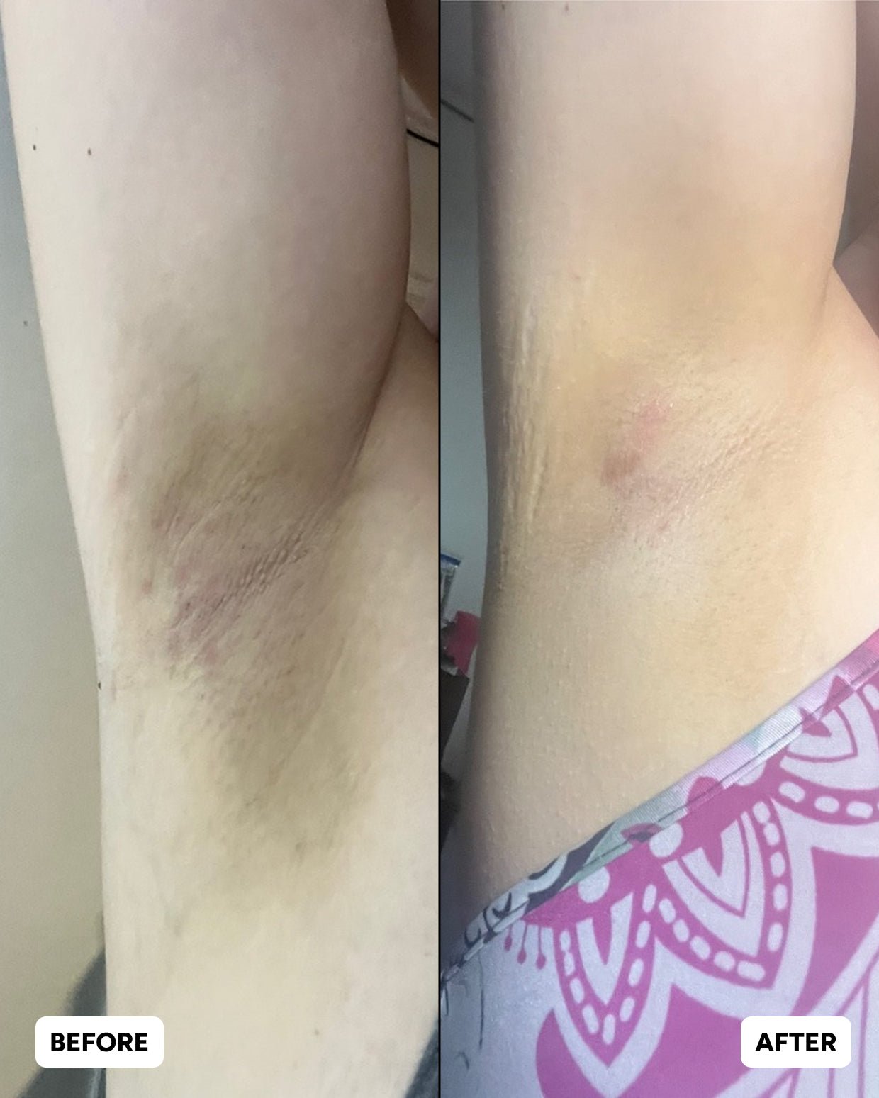 Scar & Spot Eraser Duo