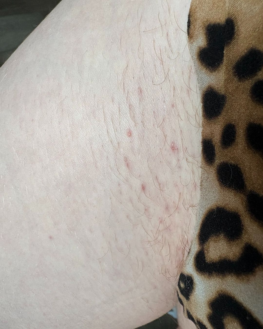 Ingrown Rescue Routine After