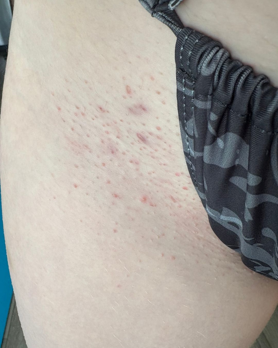 Ingrown Rescue Routine Before