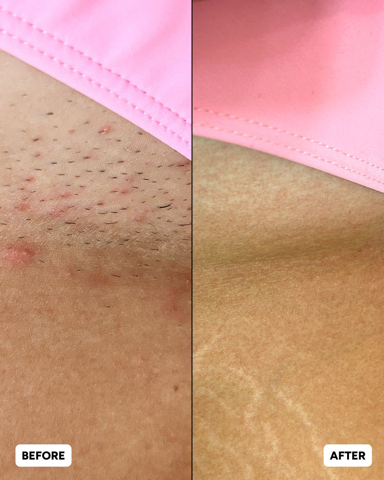 Razor Bumps Routine